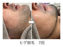 ナルシス/【脱毛】7回の変化★