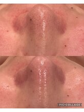 ウォーム(Warm)/40代毛穴ケア×ハーブピーリング