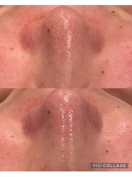 ウォーム(Warm)/40代毛穴ケア×ハーブピーリング