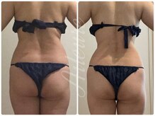 エルール トータルビューティ(Aileure total beauty)/インディバx燃焼ジェルxアミノ酸