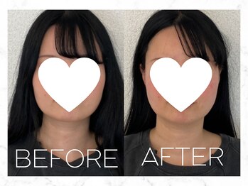 コノハナ(conohana)/フェイスラインがすっきり!