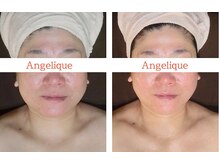 アンジェリーク/40代からの小顔矯正リフトアップ