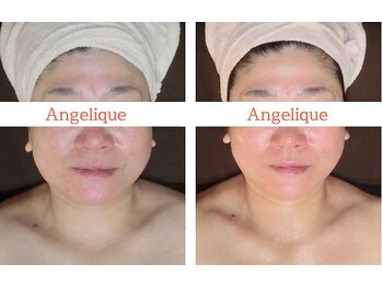 アンジェリーク/40代からの小顔矯正リフトアップ