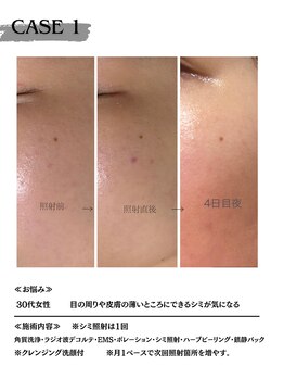 ミウル 天王寺店(miulu)/30代女性/シミ照射1回