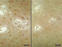 アム バイ オーキッド 代々木公園(UM by ORCHID)/毛穴・ニキビケア