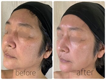 バービーフェイス 恵比寿(Barbie Face)/グリーンピールソフト1Day 1g 