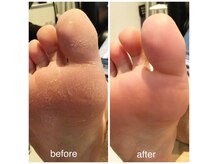足裏の角質をなんとかしたい！DXコースでお手入れ出来ます♪