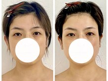 ステラルーテ(Stella lute)/脳洗浄4回集中改善コース 2回目