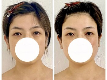 ステラルーテ(Stella lute)/脳洗浄4回集中改善コース 2回目