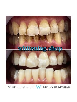 ホワイトニングショップ 光明池店/【ビフォーアフター】5回