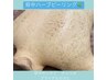 【背中のザラザラ・ケア】背中ハーブピーリング（上部or下部）11000円★