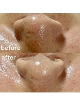 シロ(SHIRO)/毛穴洗浄でいちご鼻改善