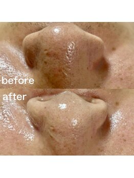 シロ(SHIRO)/毛穴洗浄でいちご鼻改善