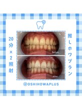 ベルプラス 新大阪(Belle plus)/Belle plus のホワイトニング