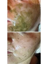 フーレスト アンド フリーリー(Fullest&Freely)/特許取得のハーブピーリング