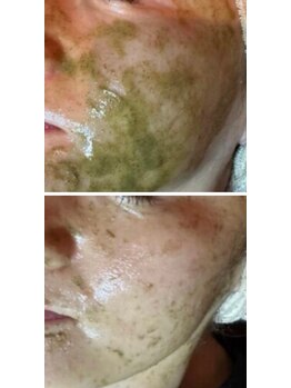 フーレスト アンド フリーリー(Fullest&Freely)/特許取得のハーブピーリング