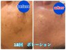 【9月限定！！】施術のみ。夏のお疲れ肌に！乾燥＆シミ・カンパンケア☆