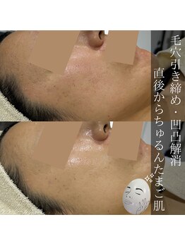 アウラプラス(Aura+)/毛穴改善症例