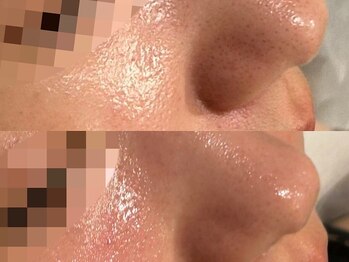 ルース 白河店(LUZ)/毛穴症例写真