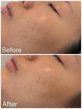 サロンドフェイス(Salon de Faith)/ハーブピーリング2回