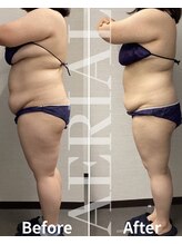 エアリアル 筑紫野店/落ちない脂肪にはコレ！！