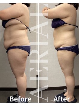 エアリアル 筑紫野店/落ちない脂肪にはコレ！！