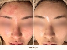 マイナプラ 表参道(myna+)/CHRISTINA/UNSTRESSピーリング