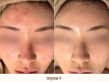 マイナプラ 表参道(myna+)/CHRISTINA/UNSTRESSピーリング