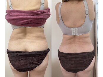 Kino Beauty Salon二子玉川店 ローマピンク/ホワイトラボ/脂肪冷却/シミ/メラニンケア/脂肪冷却