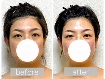 ステラルーテ(Stella lute)/脳洗浄4回集中改善コース 3回目