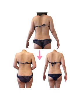 コーラル(Coral)/ブライダル痩身(施術結果)