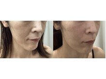 ルボン(RUBON)/　ほうれい線