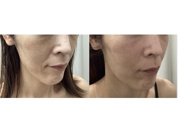 ルボン(RUBON)/　ほうれい線