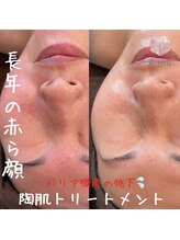 ビジュープラス ひたち野うしく店(Bijou+)/40代【赤ら顔】でお悩みのお客様