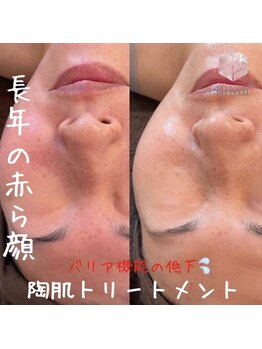 ビジュープラス ひたち野うしく店(Bijou+)/40代【赤ら顔】でお悩みのお客様