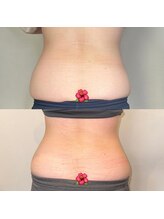 プルメリア(Plumeria)/マグニート1クール終了間際２