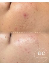 アエ(ae)/ニキビケアや赤み改善も叶う！！