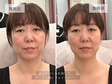 ル キヤ アイスペシャリテ ハービスENT店/ビフォーアフター◆首肩リリース