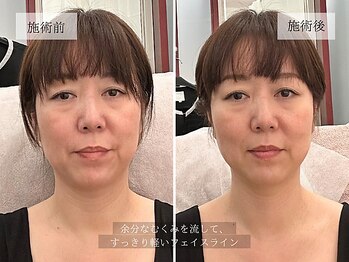 ル キヤ アイスペシャリテ ハービスENT店/ビフォーアフター◆首肩リリース