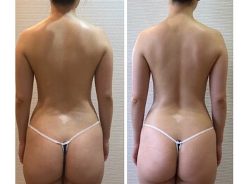 カロン(Kalon)/痩身