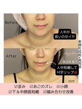 アンジェリカ(Angelica)/人中短く★顔面短縮！