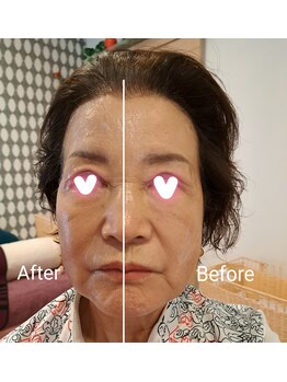 韓国エステサロン 憩/お顔のビフォーアフター