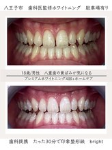 ブライト 八王子(bright)/10代男性/八王子ホワイトニング