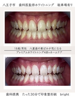 ブライト 八王子(bright)/10代男性/八王子ホワイトニング