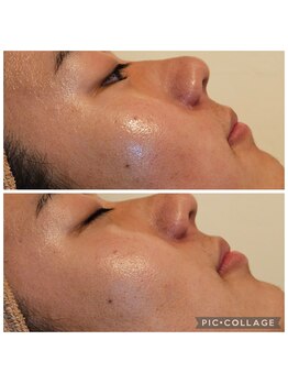 ミホズルーム(Miho‘s room)/水光肌ピーリング♪