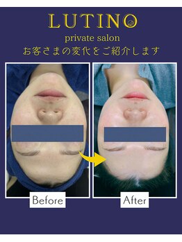 ルチノ(LUTINO)/剥離なしピーリング20代1回