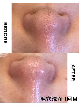 マヴィ くずは店(MavY.)/毛穴ケアでスッキリ!