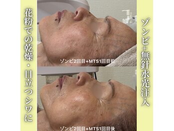 ハニエル(Haniel)/ゾンビマスク+無針水光注入症例