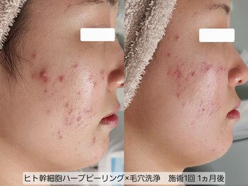 サロンドリー(salon de Re)/ハーブピーリング×毛穴洗浄 1回