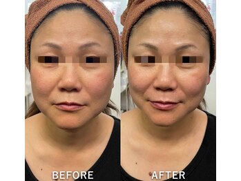 リラクゼーションサロン ラキ(laki)/サーモシェイプDEEP40代後半